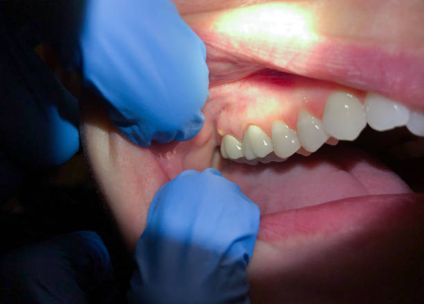 Best Emergency Dental Care for Broken or Chipped Teeth in Tri City, OR